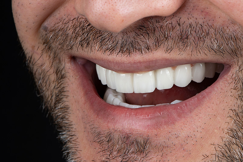 Dental bridge