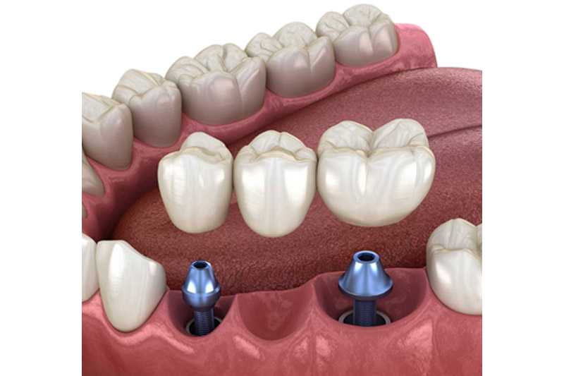 Dental bridge