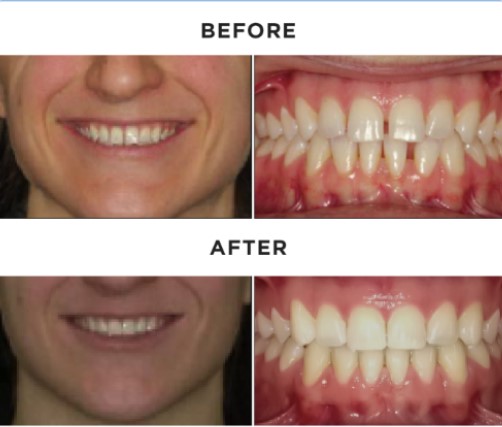SureSmile Clear aligners in Orland Park