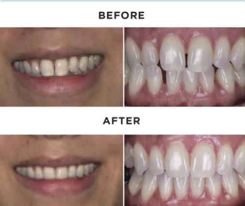 SureSmile Clear aligners in Orland Park