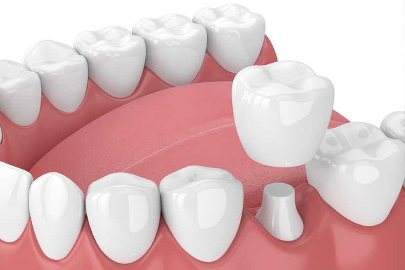 Dental Crowns in Orland Park