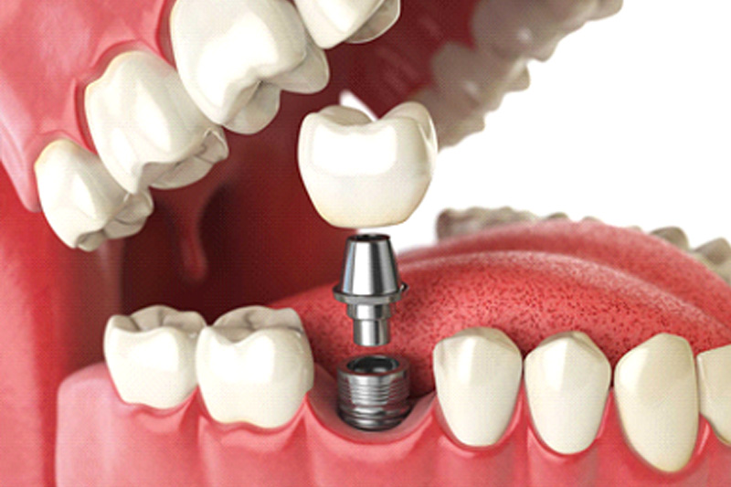 Dental Crowns in Orland Park