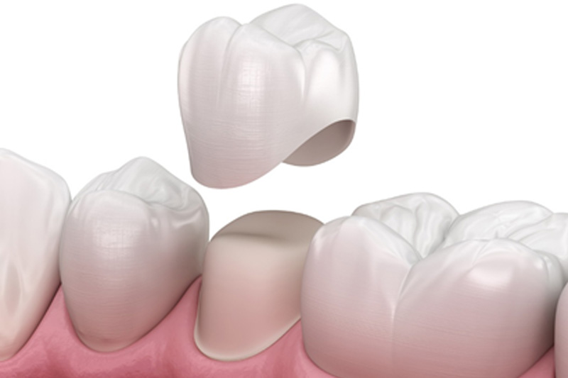Dental Crowns in Orland Park