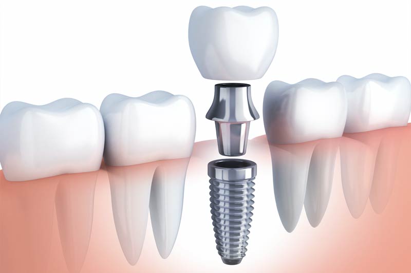 Implants Dentist in Orland Park
