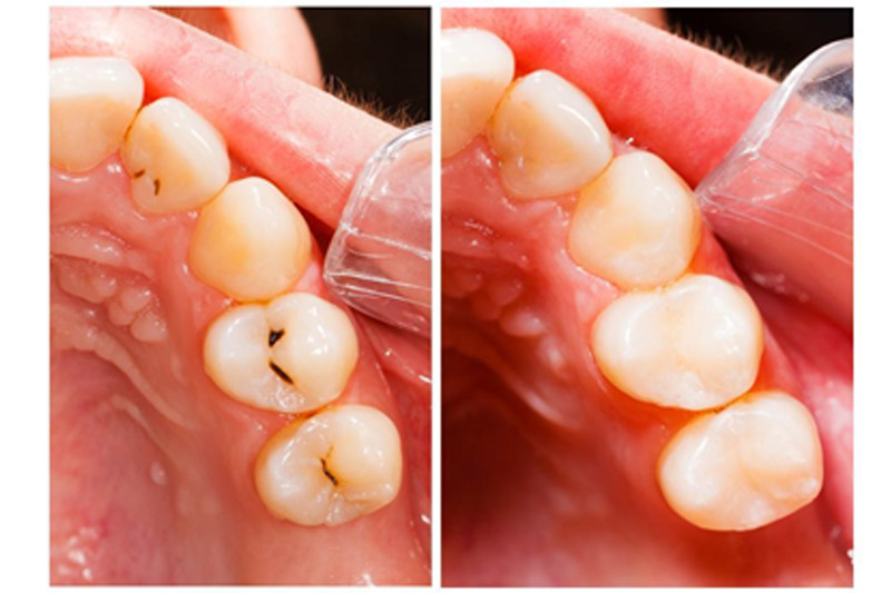 Dental Fillings in Orland Park