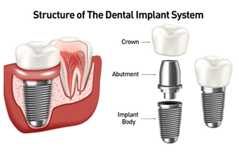 Implants Dentist in Orland Park