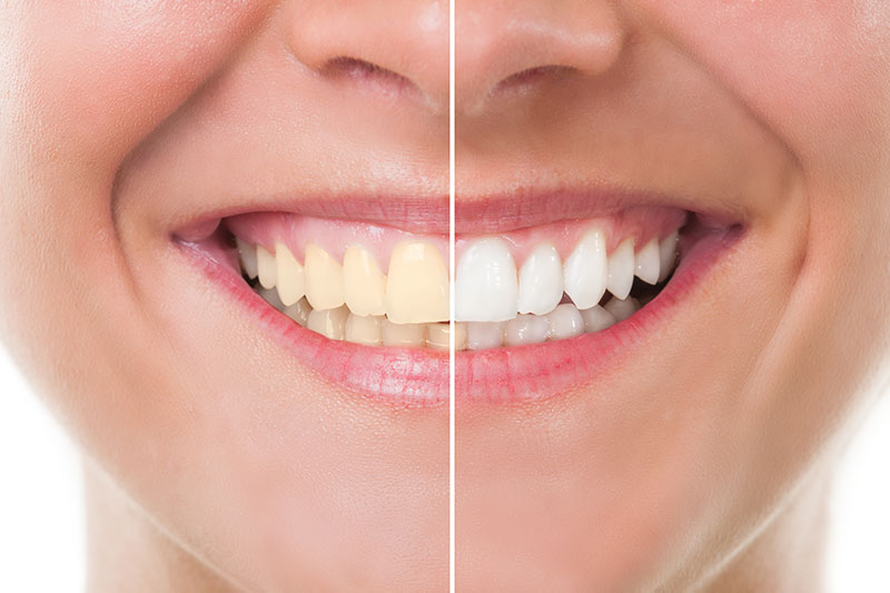 Teeth Whitening in Orland Park